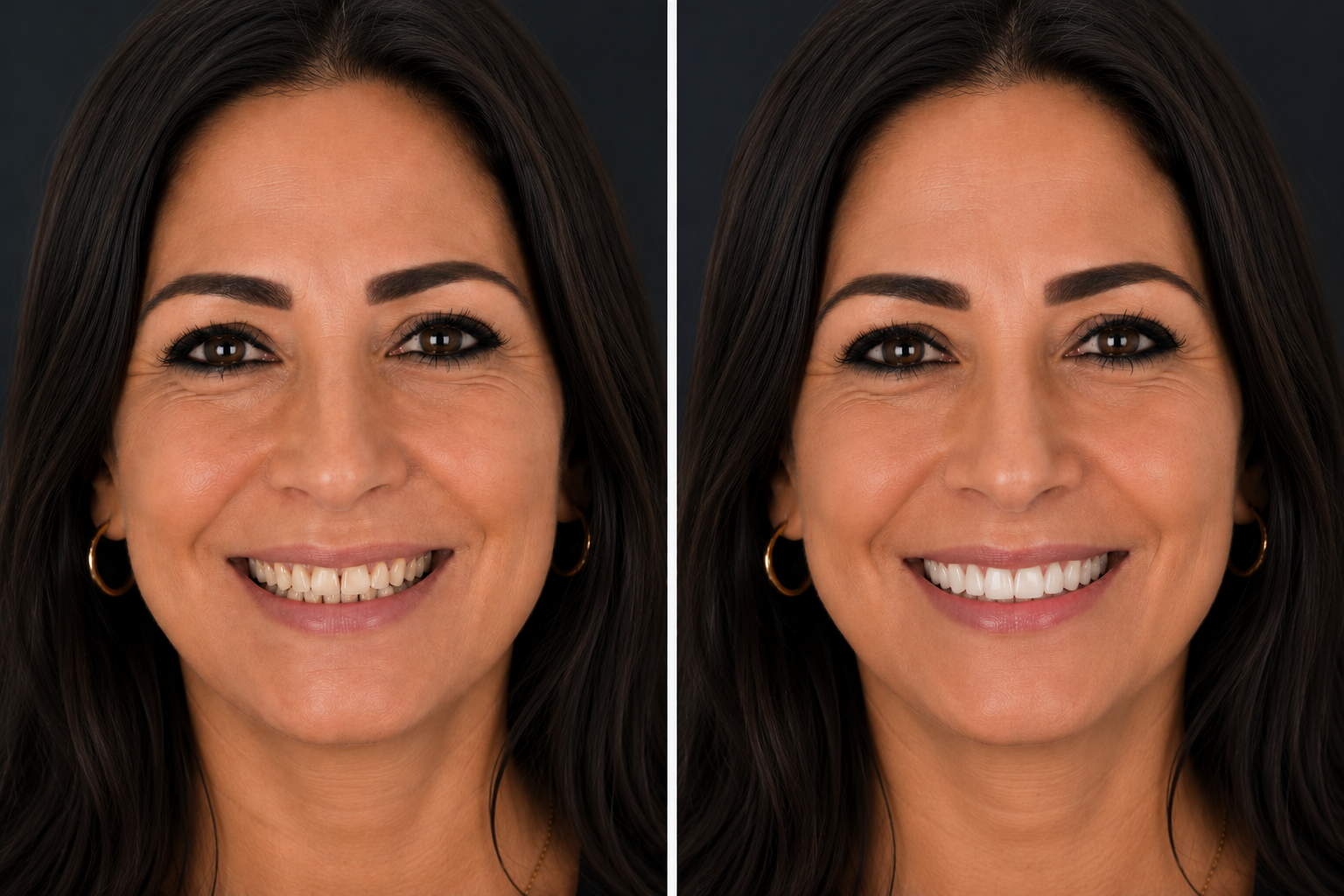 Hollywood Smile Vorher Nachher Türkei